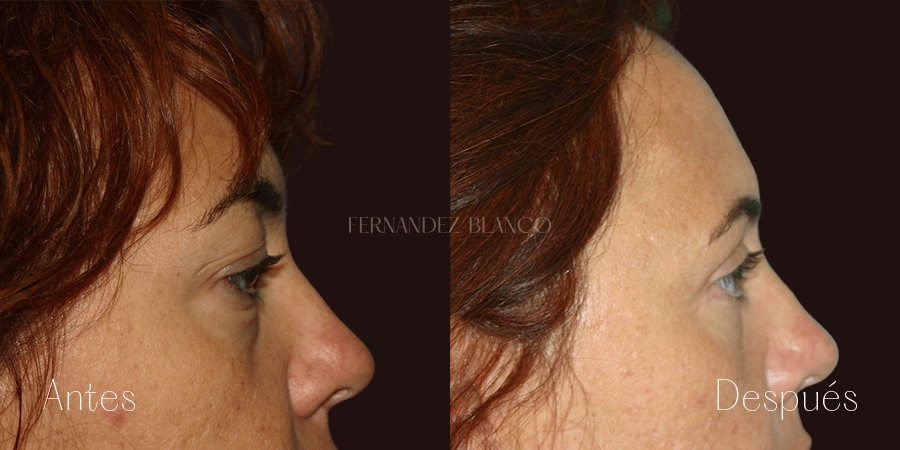 Blefaroplastia superior con 3 meses de evolución realizada por el Dr. Fernández Blanco a paciente Sara