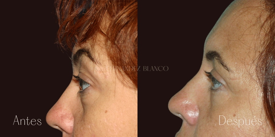 Perfil izquierdo de Sara antes y después de realizarse una blefaroplastia superior en la Clínica Fernández Blanco