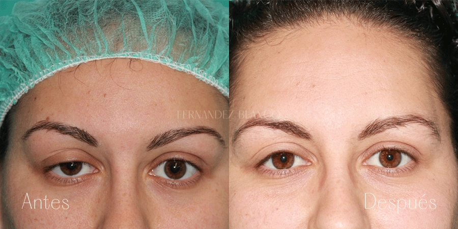 Vista frontal del antes y después de una cirugía de Ptosis palpebral congénita con 3 meses de evolución realizada por el Dr. Fernández Blanco