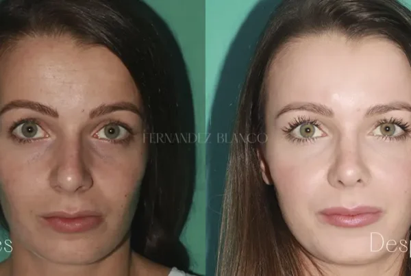 Comparación frontal del antes y después de 6 meses de una operación de rinoplastia abierta realizada por el Dr. Férnandez Blanco