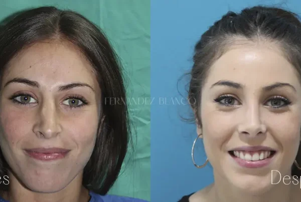 Antes y después de una rinoplastia abierta. Fotografía vista frontal. Caso de Irene