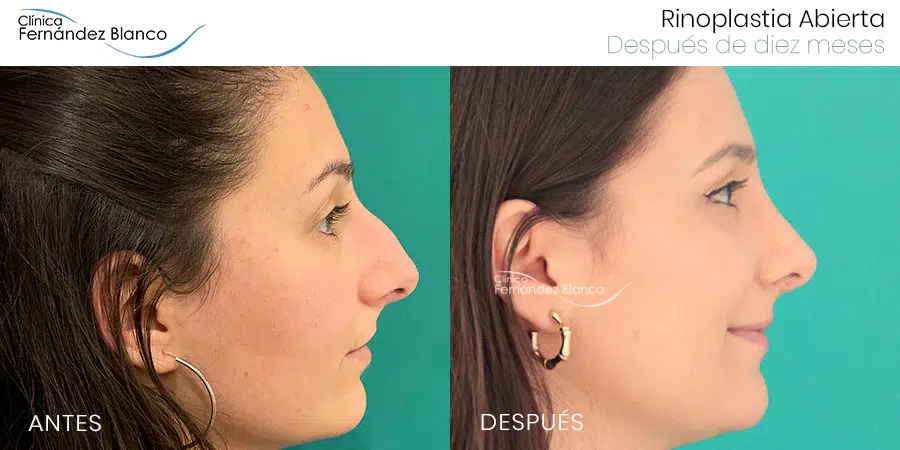 How Much Does Rhinoplasty Cost in Madrid and Málaga?