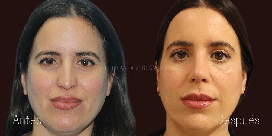 Vista frontal del caso de antes y después de rinoplastia abierta realizada a Antonia en la Clínica Fernández Blanco