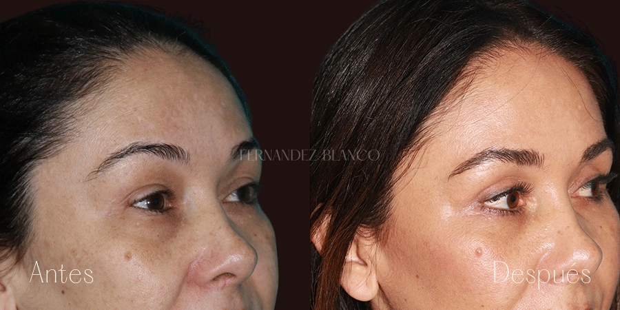 Antes y después de Gabriela tras realizarse una blefaroplastia superior e inferior, también conocida como blefaroplastia completa, en la Clínica Fernández Blanco