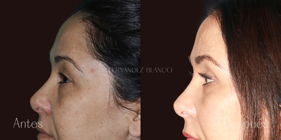 Antes y después del perfil izquierdo de Gabriela tras realizarse una blefaroplastia superior e inferior con el Dr. Fernández Blanco