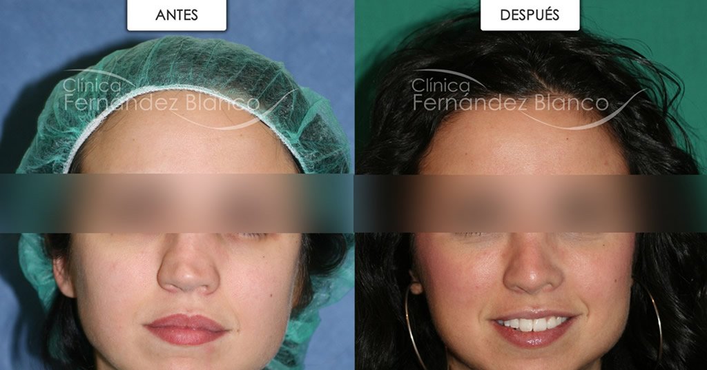 Rinoplastia Secundaria Una Segunda Oportunidad Para La Nariz Dr Fernandez Blanco